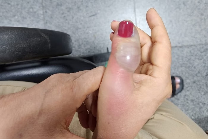 Infecção na unha | Foto: Reprodução/Acervo Pessoal