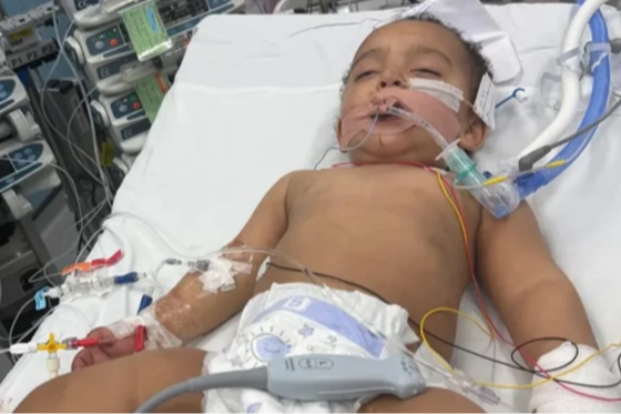 FireShot Capture 557 - Bebê perde metade da língua após confundir soda cáustica com leite_ - [www.metropoles.com].png