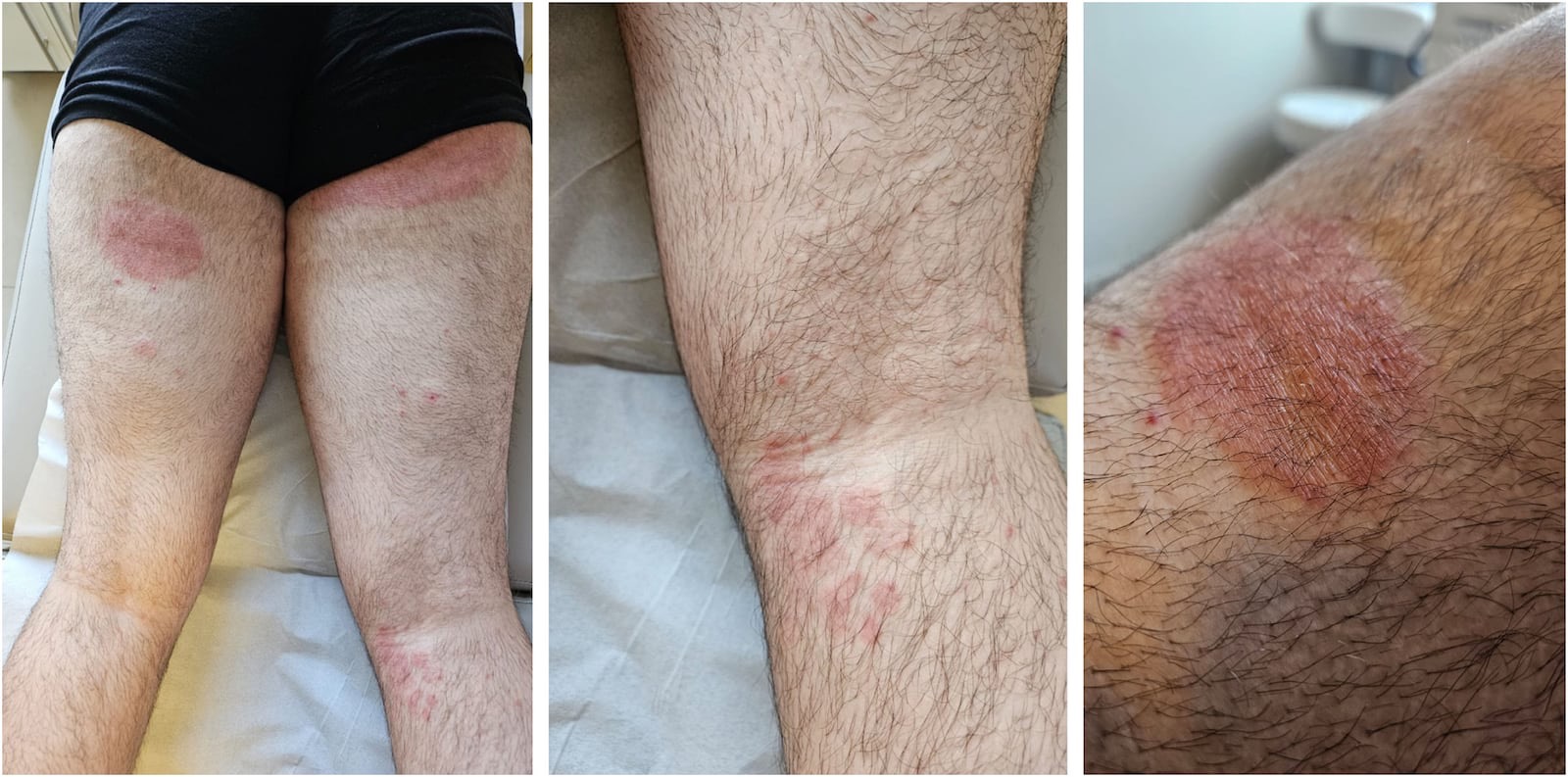 “superfungo” genital conhecido como T. indotineae | Veasey et al., 2025/Anais Brasileiros de Dermatologia