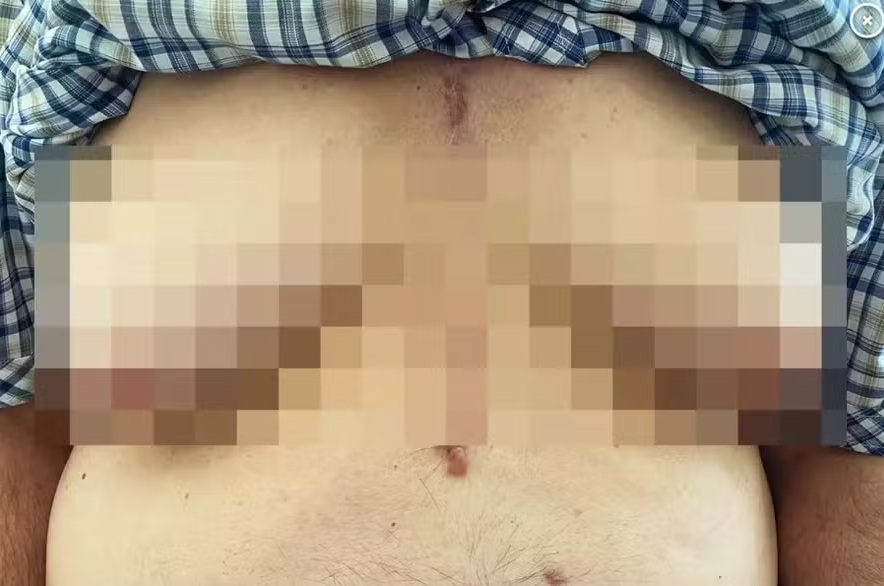 FireShot Capture 783 - Idoso desenvolve 'seios' após tomar medicamento para condição cardí_ - [extra.globo.com].png