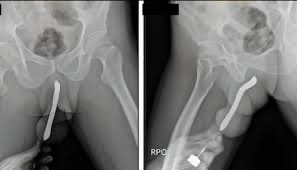 Banco de dados dos EUA revela os objetos mais inseridos nos órgãos sexuais masculino e feminino; veja lista