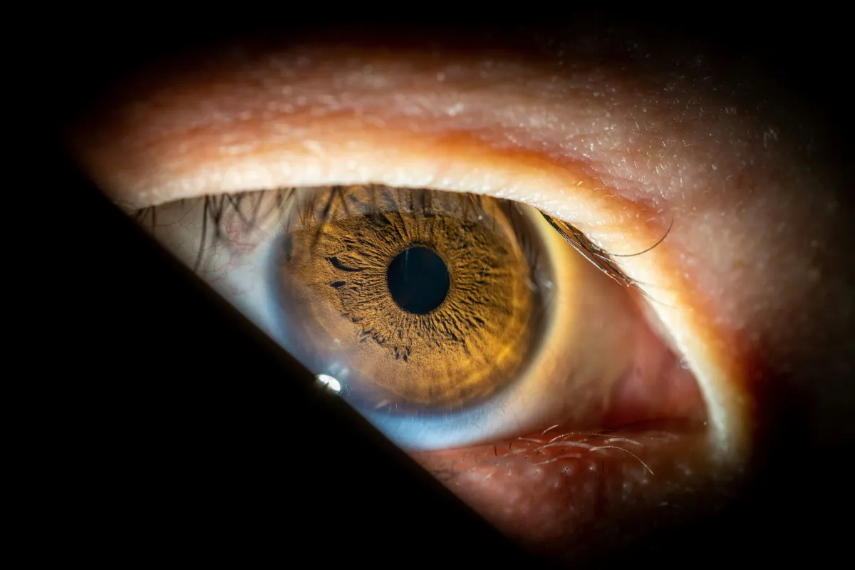 olhos_catarata.webp